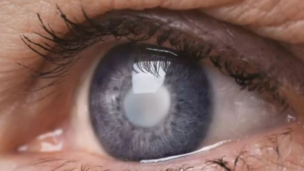 ¿Una persona joven puede padecer cataratas? ¿Una persona joven puede padecer cataratas?