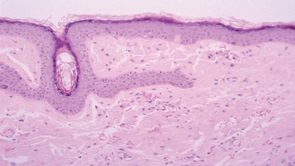 ¿Qué es la amiloidosis? ¿Qué es la amiloidosis?