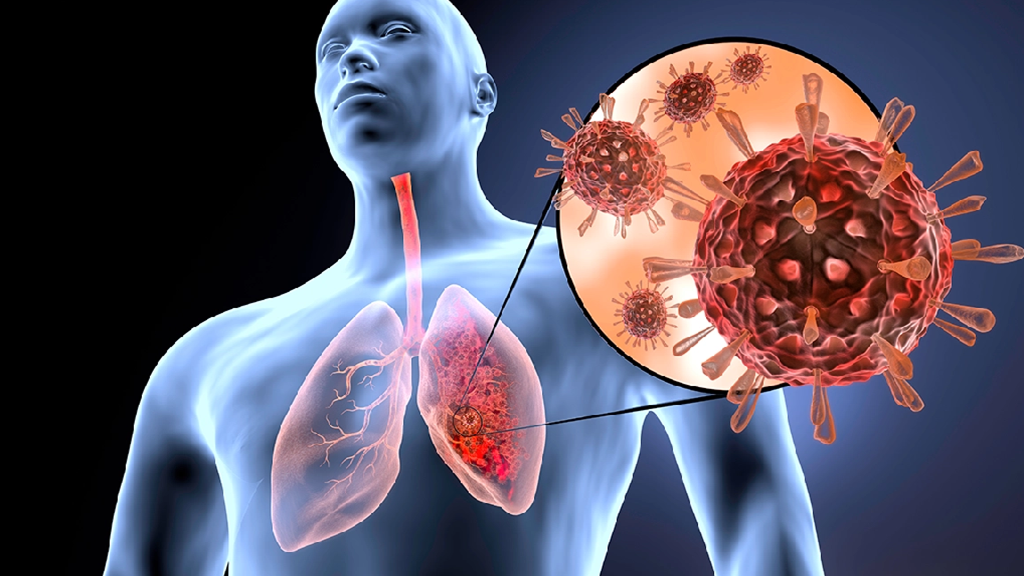 Enfermedades respiratorias: tipos, síntomas y prevención Enfermedades respiratorias: tipos, síntomas y prevención